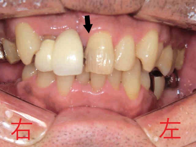 インプラント症例50代男性
