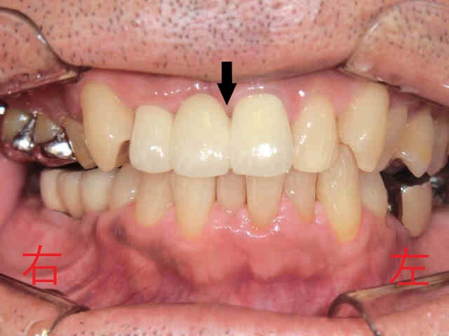 インプラント症例50代男性
