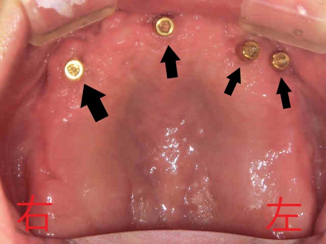 インプラント症例50代男性