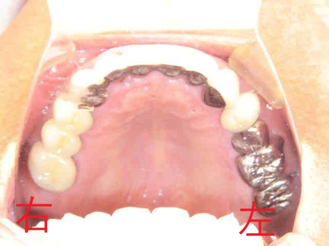 インプラント症例　７０代男性