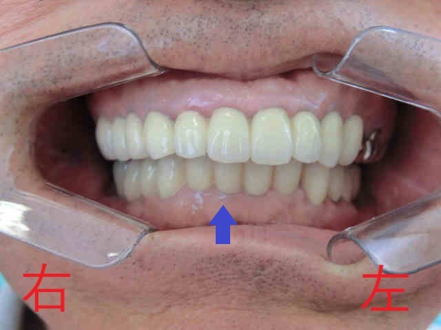 インプラント症例　７０代男性