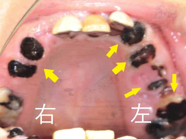 インプラント症例　３０代男性　術前