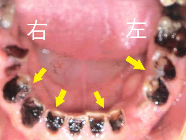 インプラント症例　３０代男性　術前