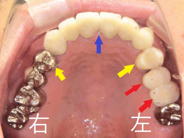 インプラント症例　３０代男性　術後