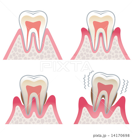 歯周病ってどんな病気？