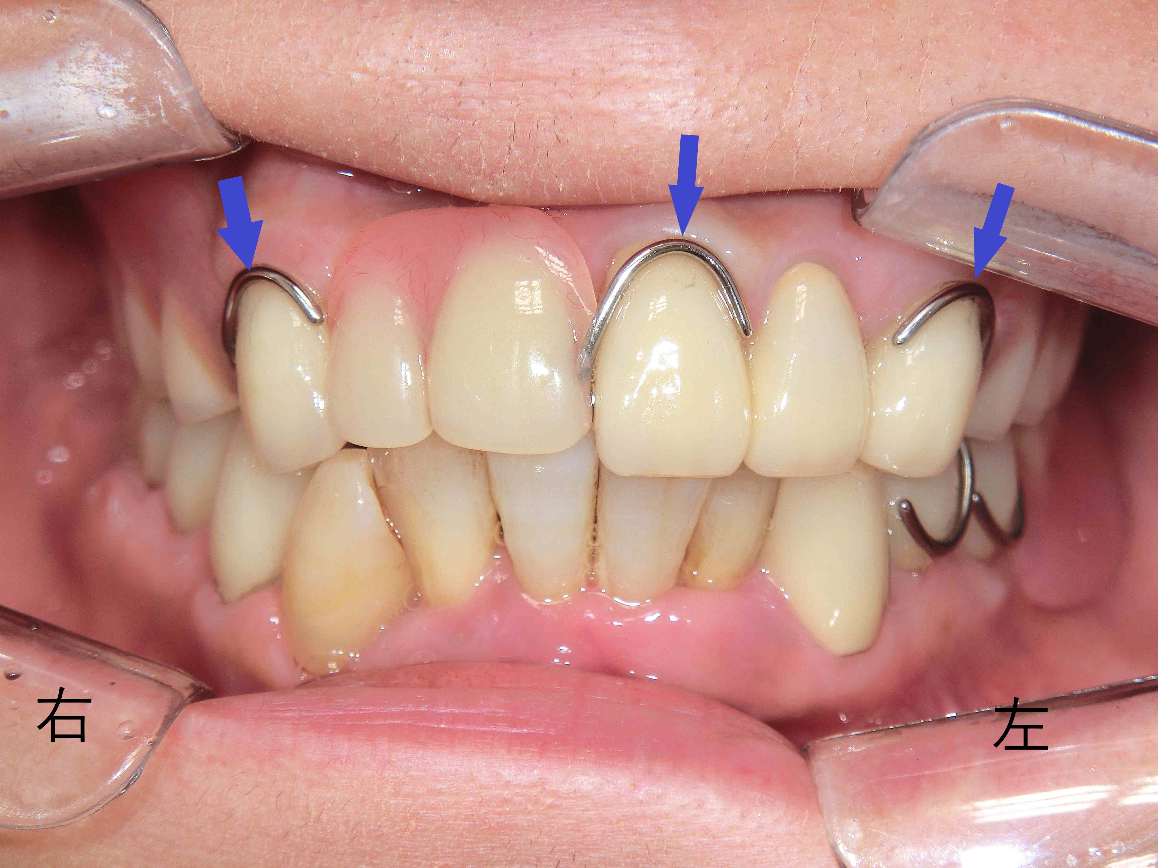金属製のバネを使用しない入れ歯(ノンクラスプデンチャー)症例　50代女性
