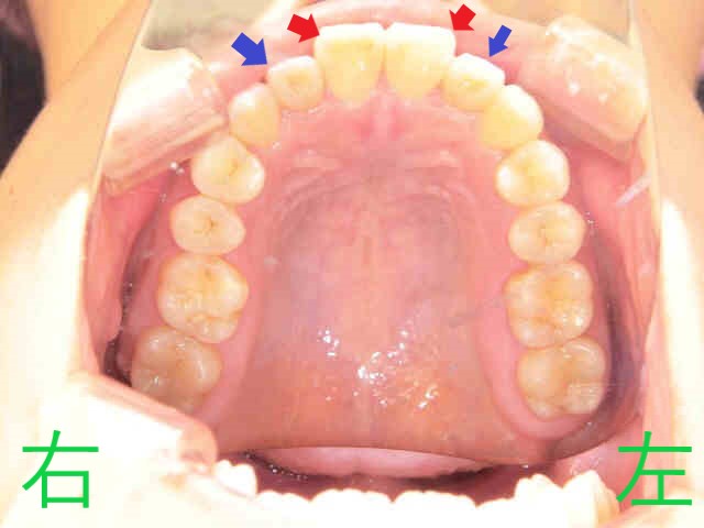 マウスピース矯正(スマイルトゥルー)症例　20代女性＜当院勤務の歯科衛生士＞術前