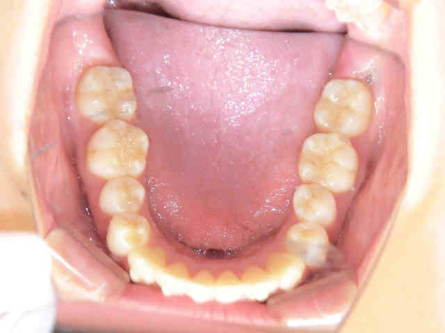 マウスピース矯正(スマイルトゥルー)症例　20代女性＜当院勤務の歯科衛生士＞術前