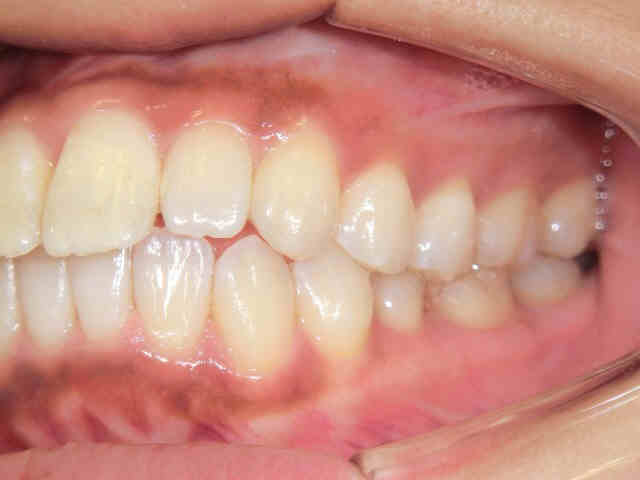マウスピース矯正(スマイルトゥルー)症例　20代女性＜当院勤務の歯科衛生士＞術後