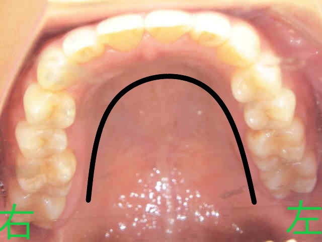 マウスピース矯正(スマイルトゥルー)症例　20代女性＜当院勤務の歯科衛生士＞術後