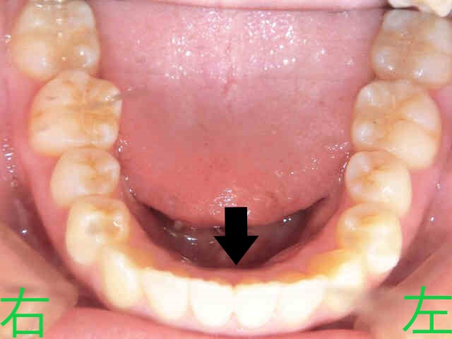 マウスピース矯正(スマイルトゥルー)症例　20代女性＜当院勤務の歯科衛生士＞術後