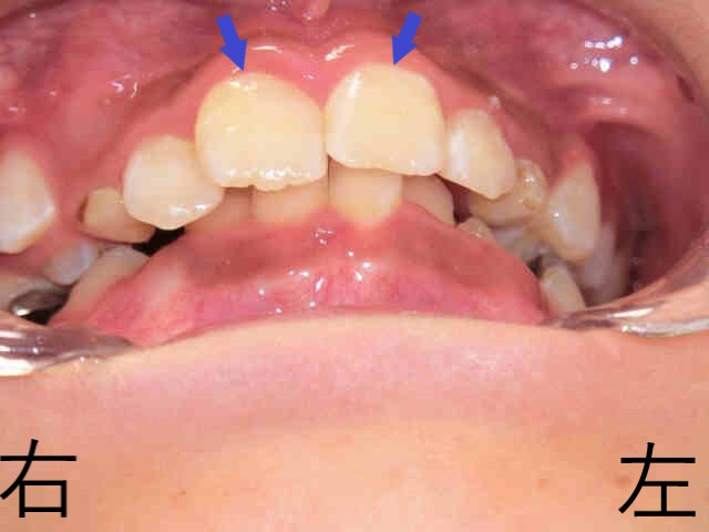 小児矯正症例　10歳6か月女性 ②