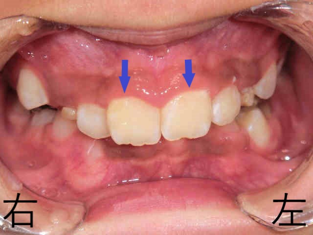 小児矯正症例　10歳6か月女性 ②