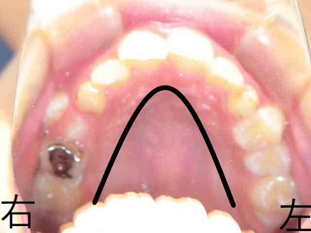 小児矯正症例　10歳6か月女性 ②