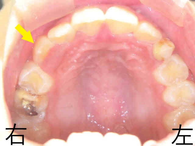 小児矯正症例　10歳6か月女性③