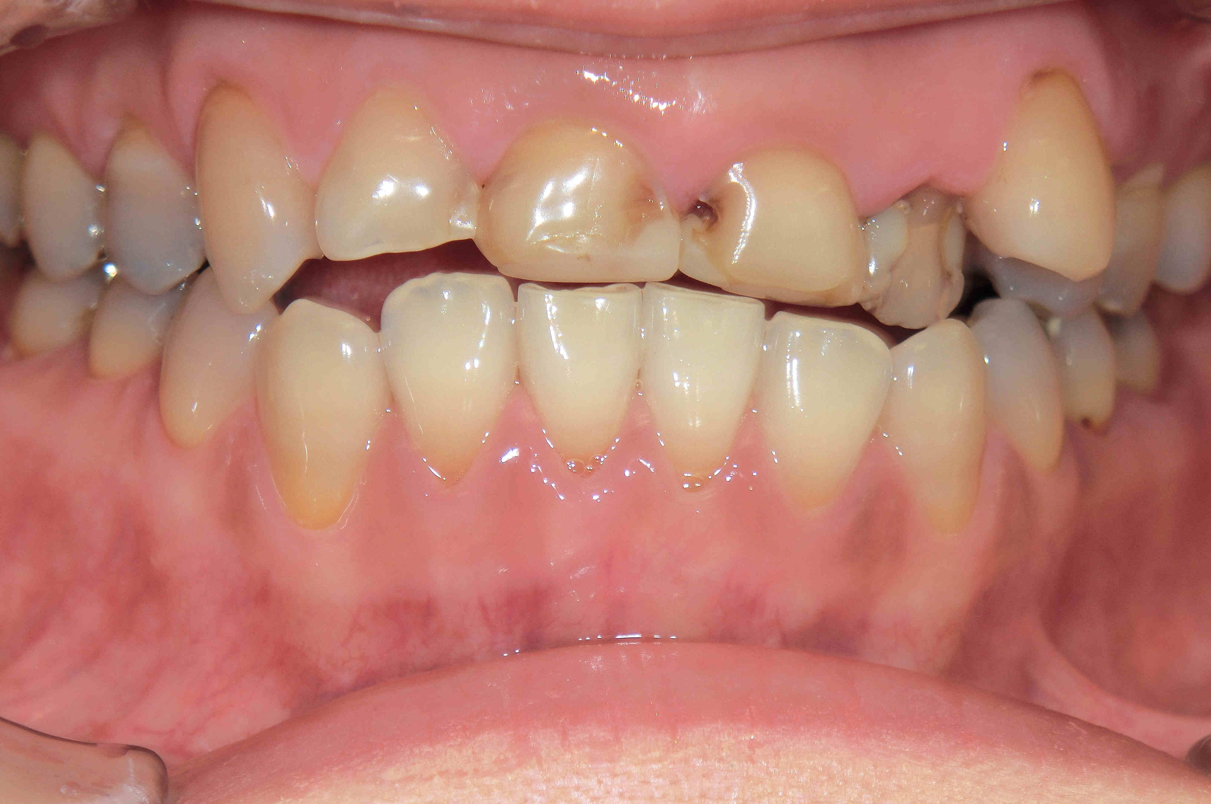 ５０代女性のセラミック冠による上顎前歯の審美回復症例