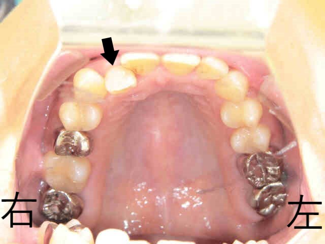部分矯正<プチ矯正>症例40代女性