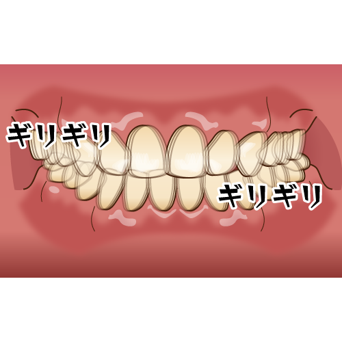 歯ぎしり・くいしばりしていませんか？