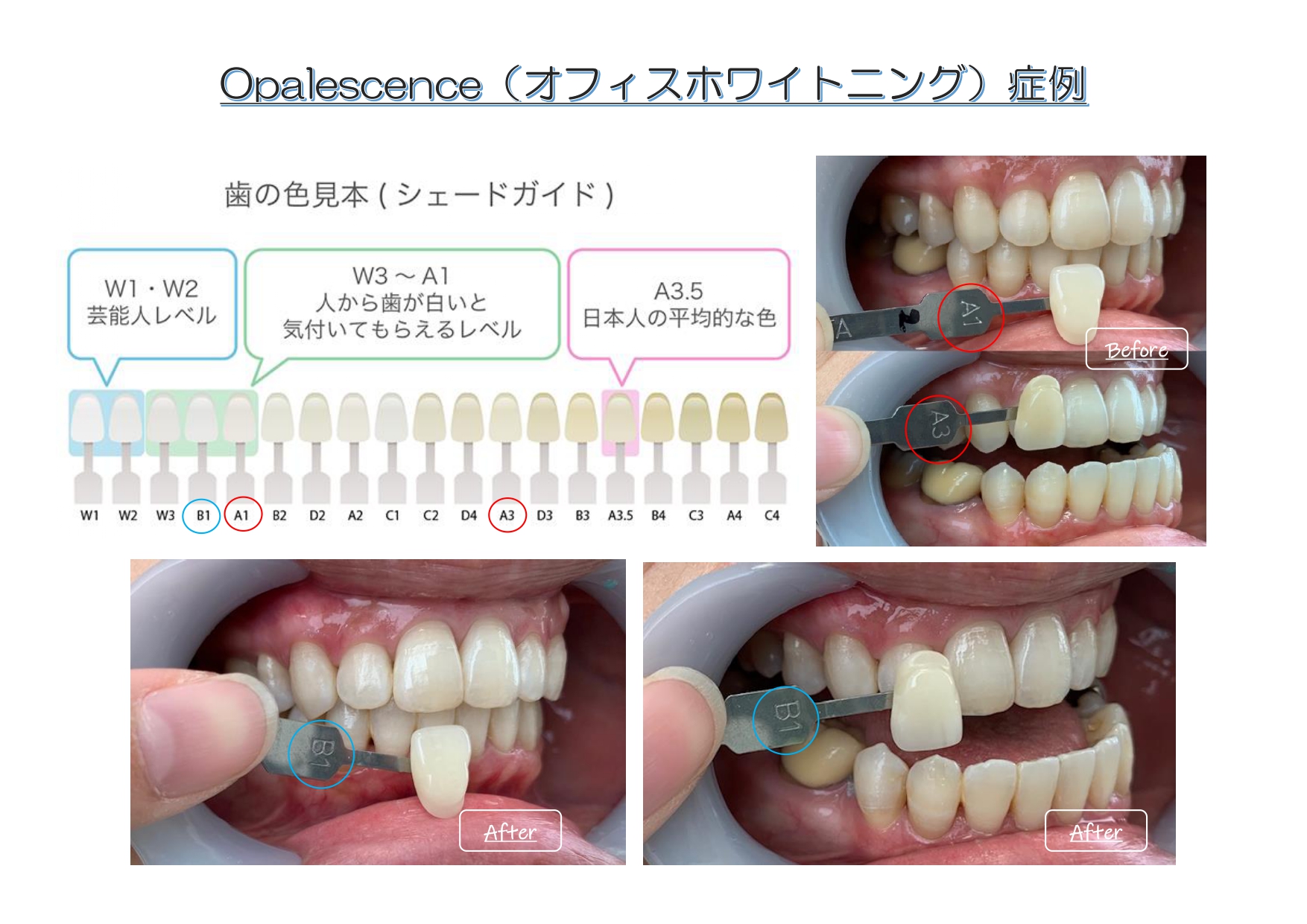 歯のホワイトニングでイメージチェンジ(^O^)／