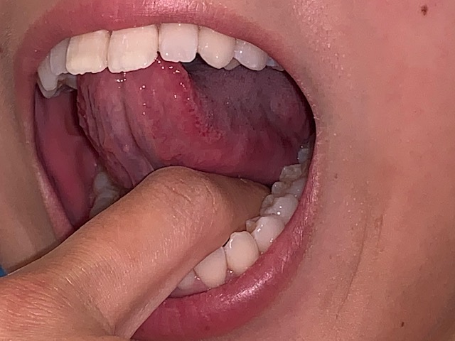 舌をはがす？！
