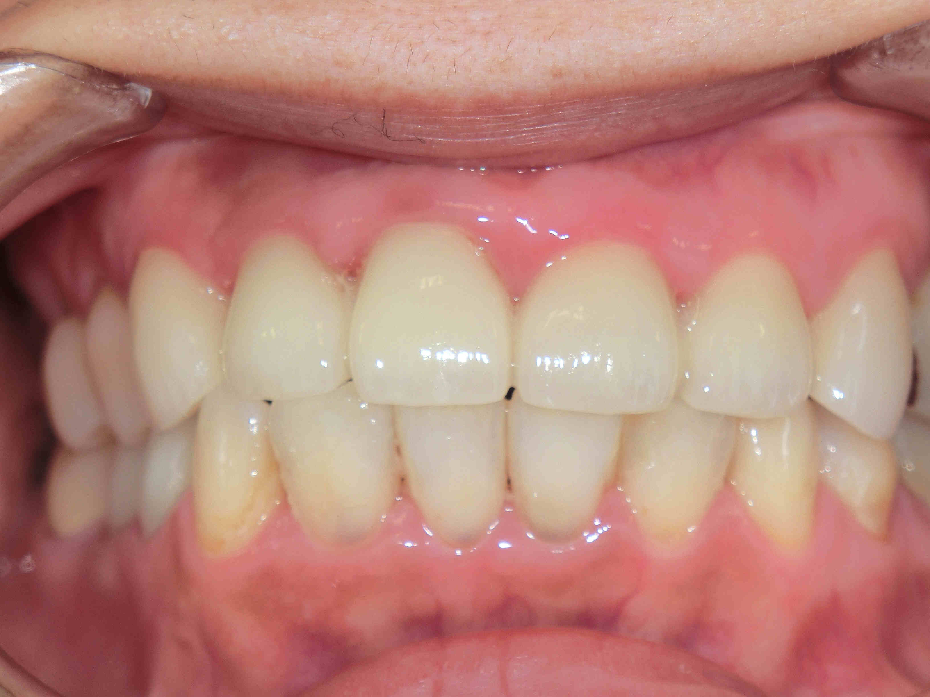 40代女性のセラミック冠による上顎前歯の審美回復症例