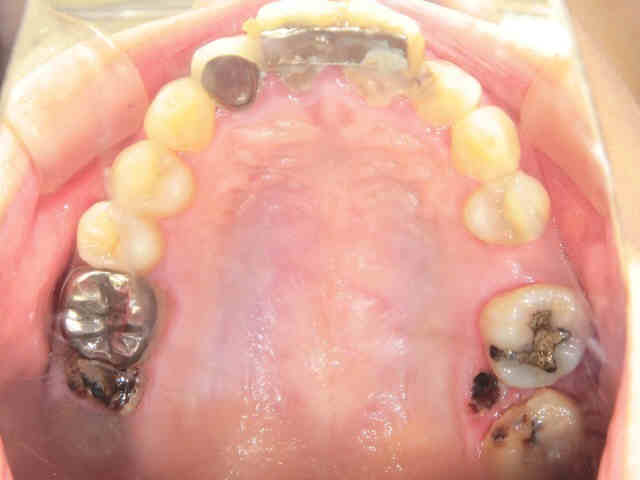 40代女性のセラミック冠による上顎前歯の審美回復症例