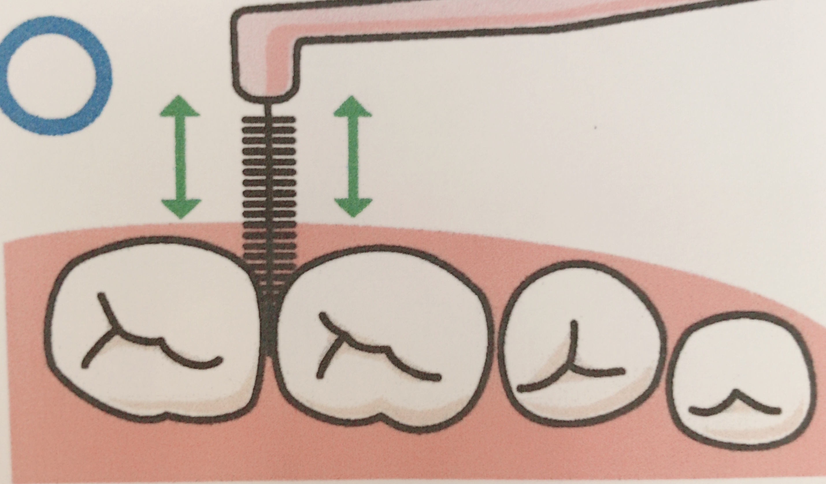 歯間ブラシ使ってますか？