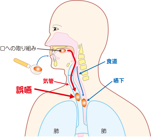 最近むせることはないですか？？