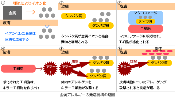 金属アレルギー　②