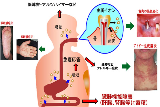 金属アレルギー③