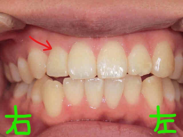 部分矯正症例　20代女性