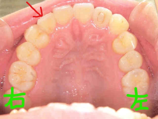 部分矯正症例　20代女性