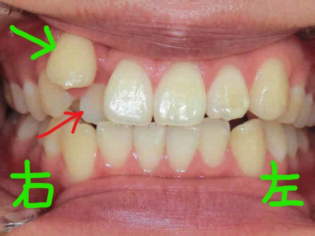 部分矯正症例　20代女性