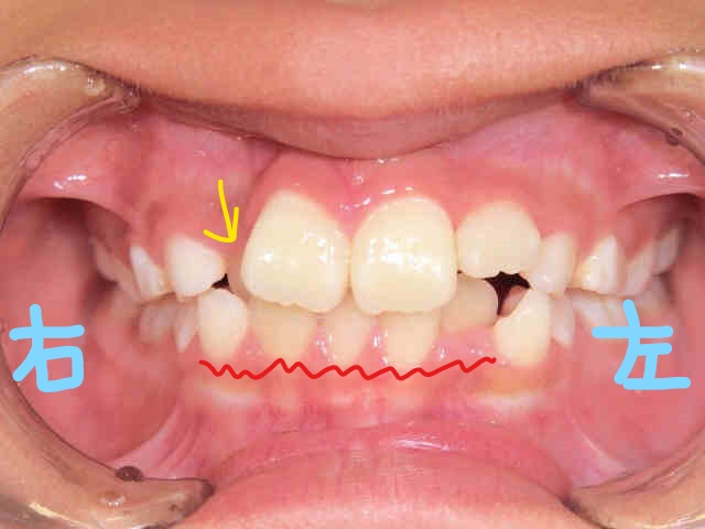小児矯正〈子供さんの矯正〉症例1