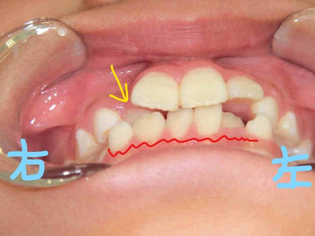小児矯正〈子供さんの矯正〉症例1