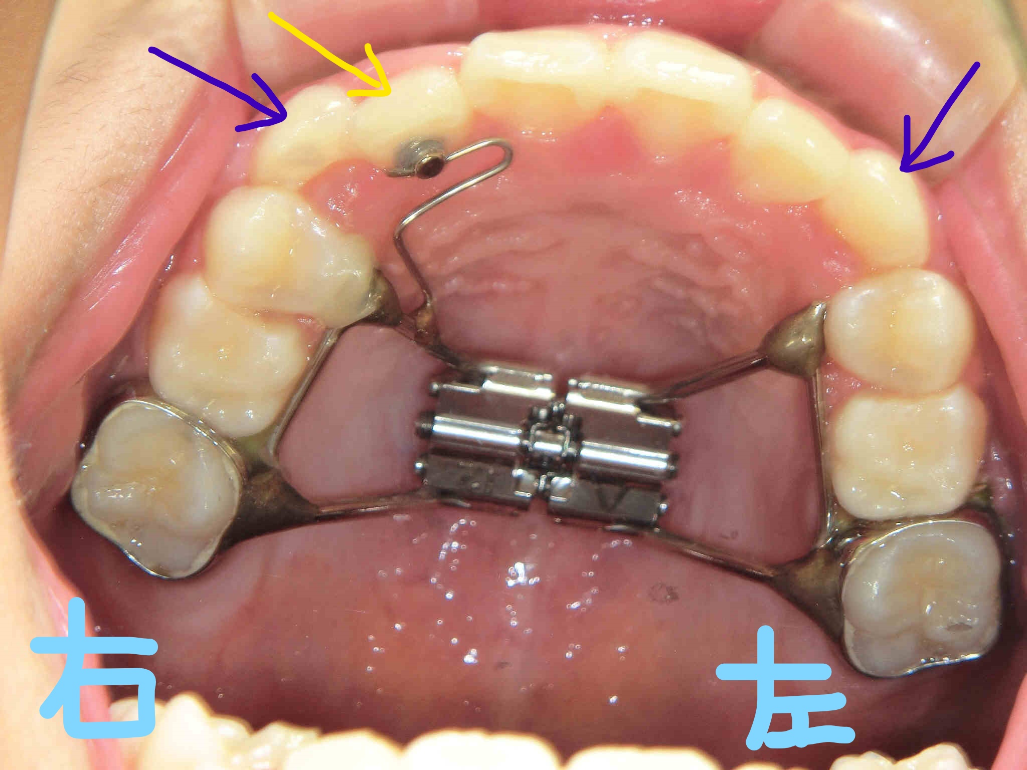 小児矯正〈子供さんの矯正〉症例１その３