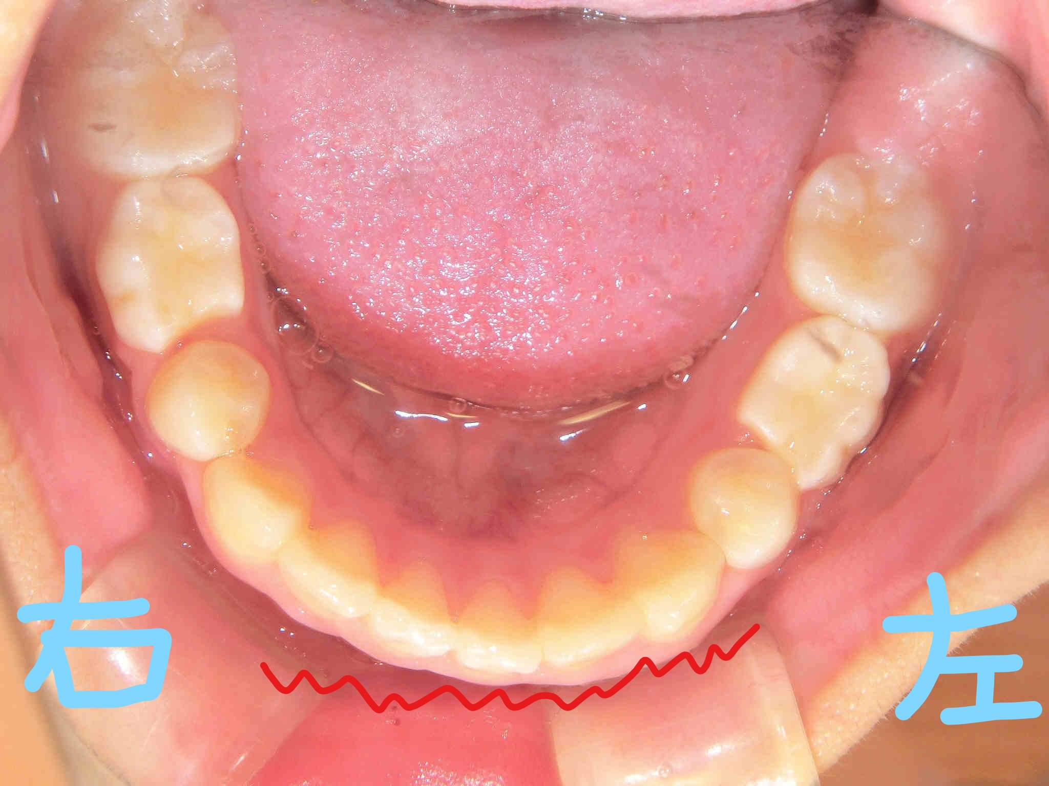 小児矯正〈子供さんの矯正〉症例１その３