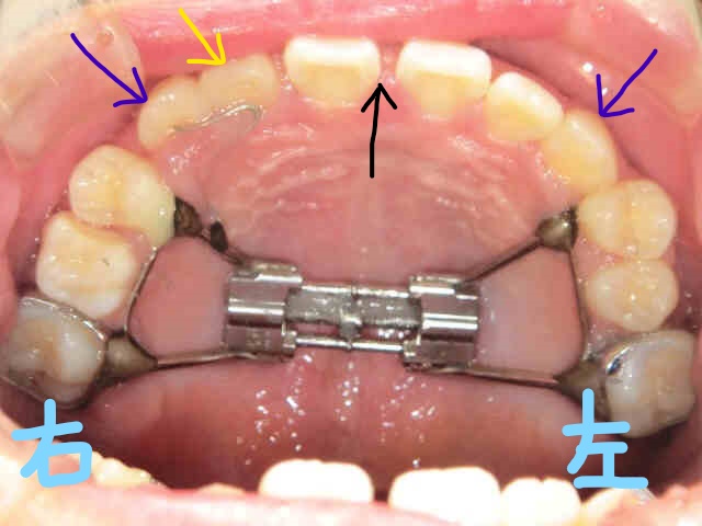 小児矯正〈子供さんの矯正〉症例１その４