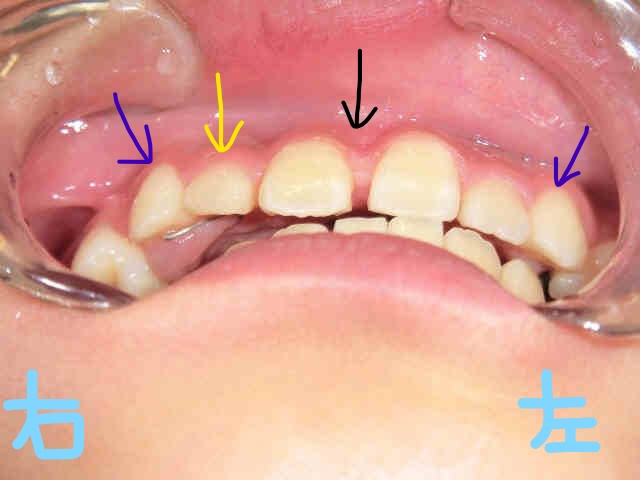 小児矯正〈子供さんの矯正〉症例１その４
