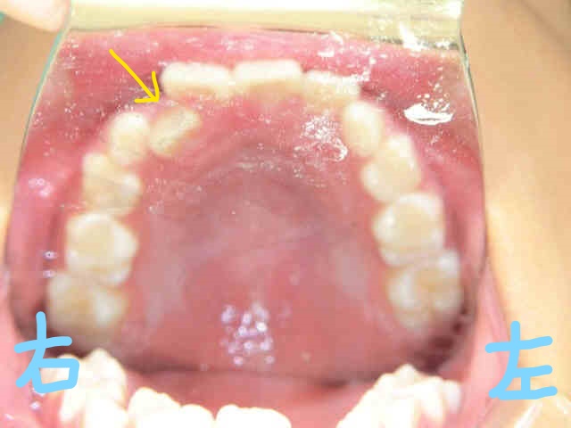 小児矯正〈子供さんの矯正〉症例１その６