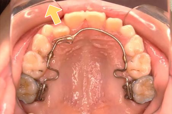 小児矯正〈子供さんの矯正〉症例１その７