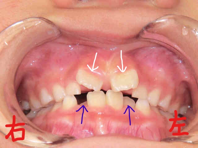 小児矯正〈子供さんの矯正〉症例２-１
