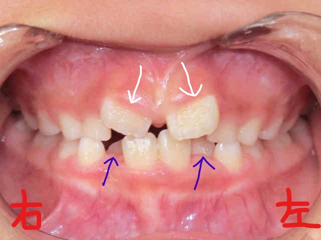 小児矯正〈子供さんの矯正〉症例２その２