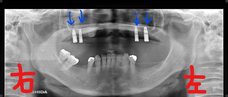 インプラント症例50代女性