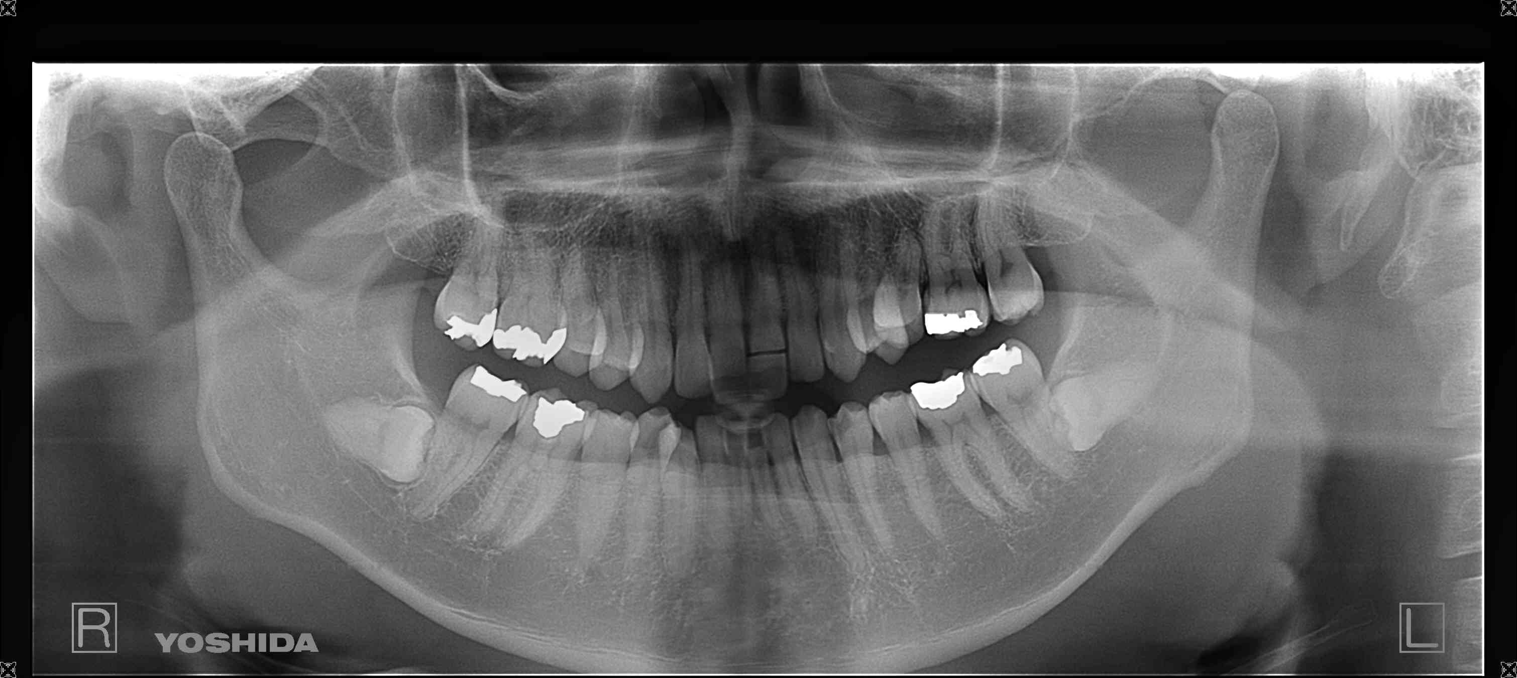 術後レントゲン