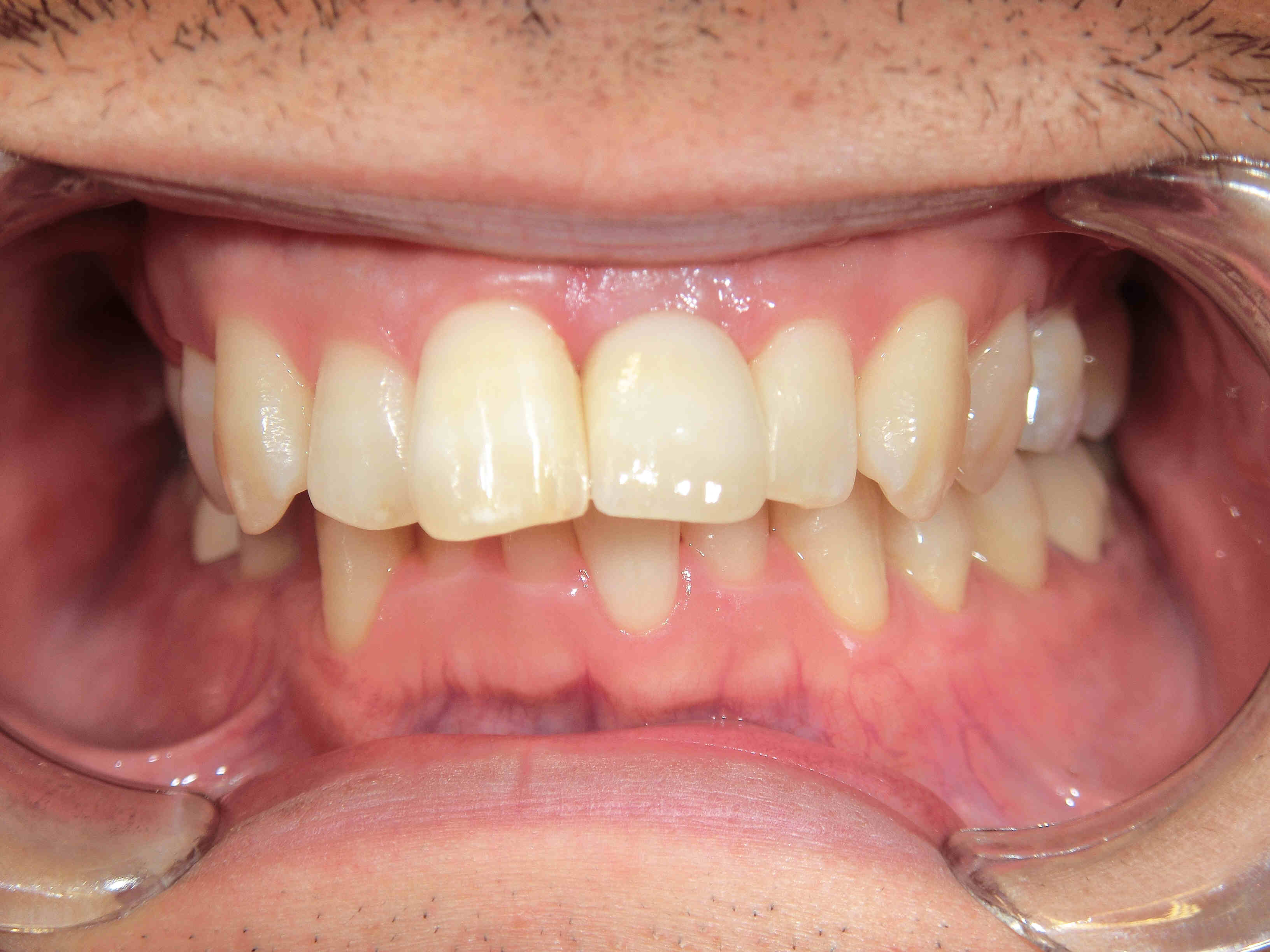 術前レントゲン