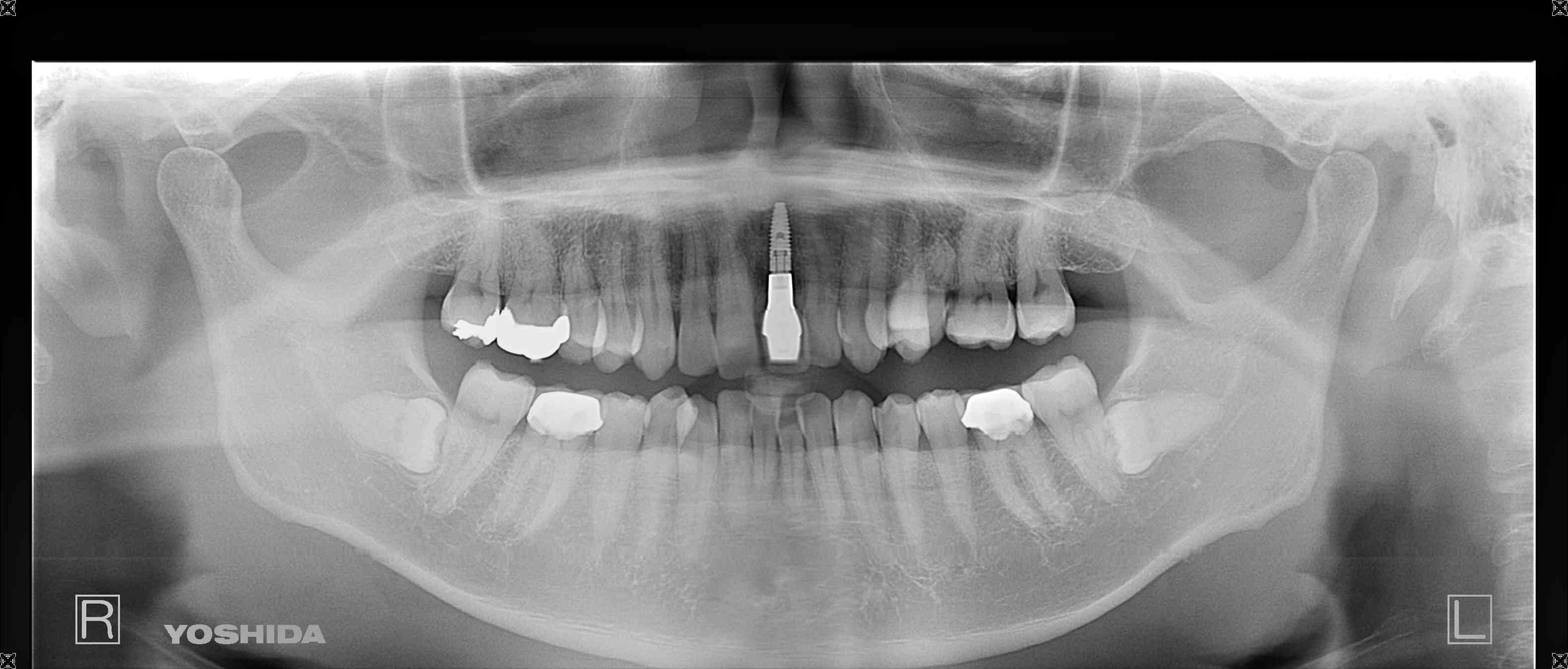 術後レントゲン