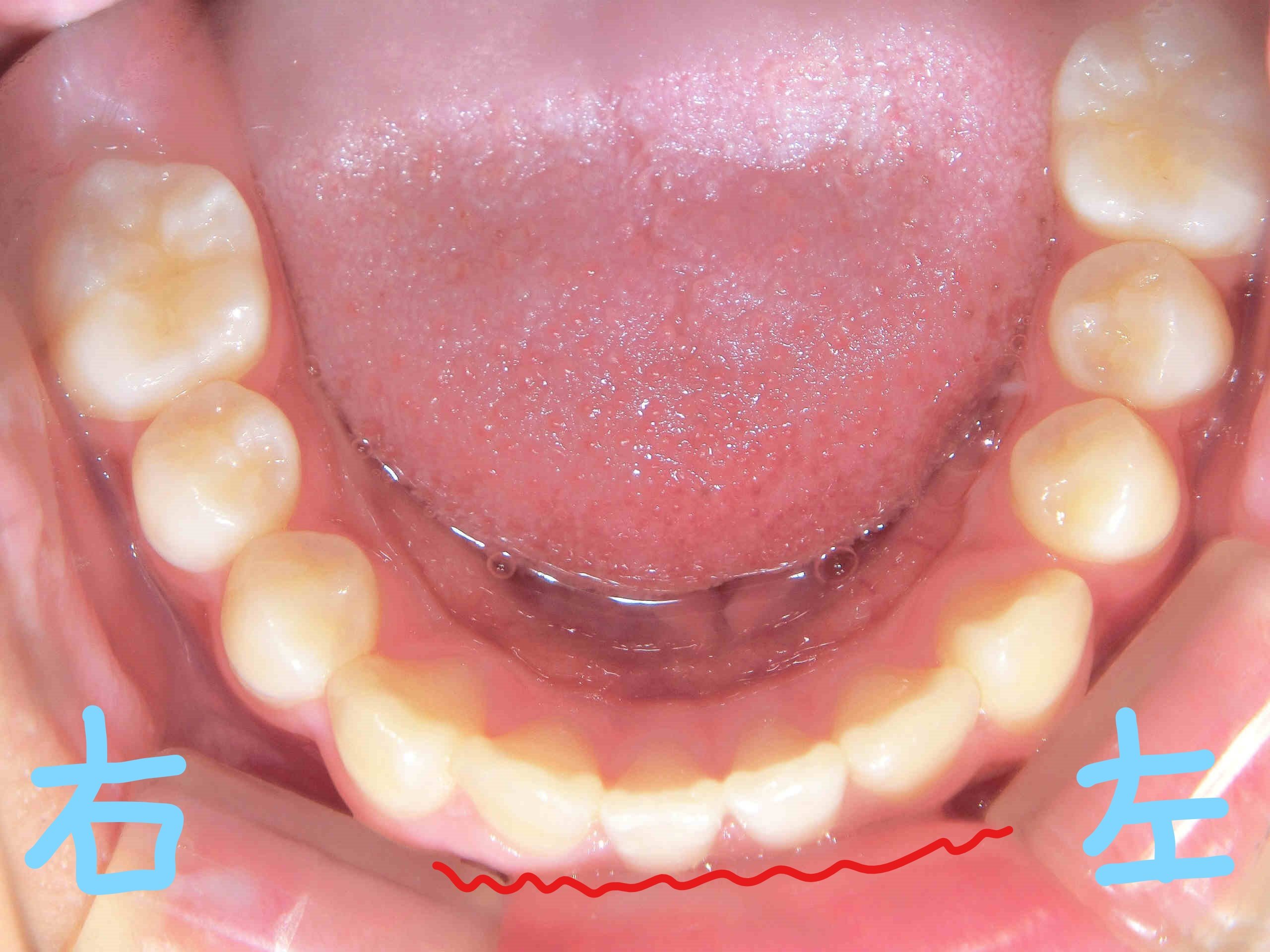 術後レントゲン