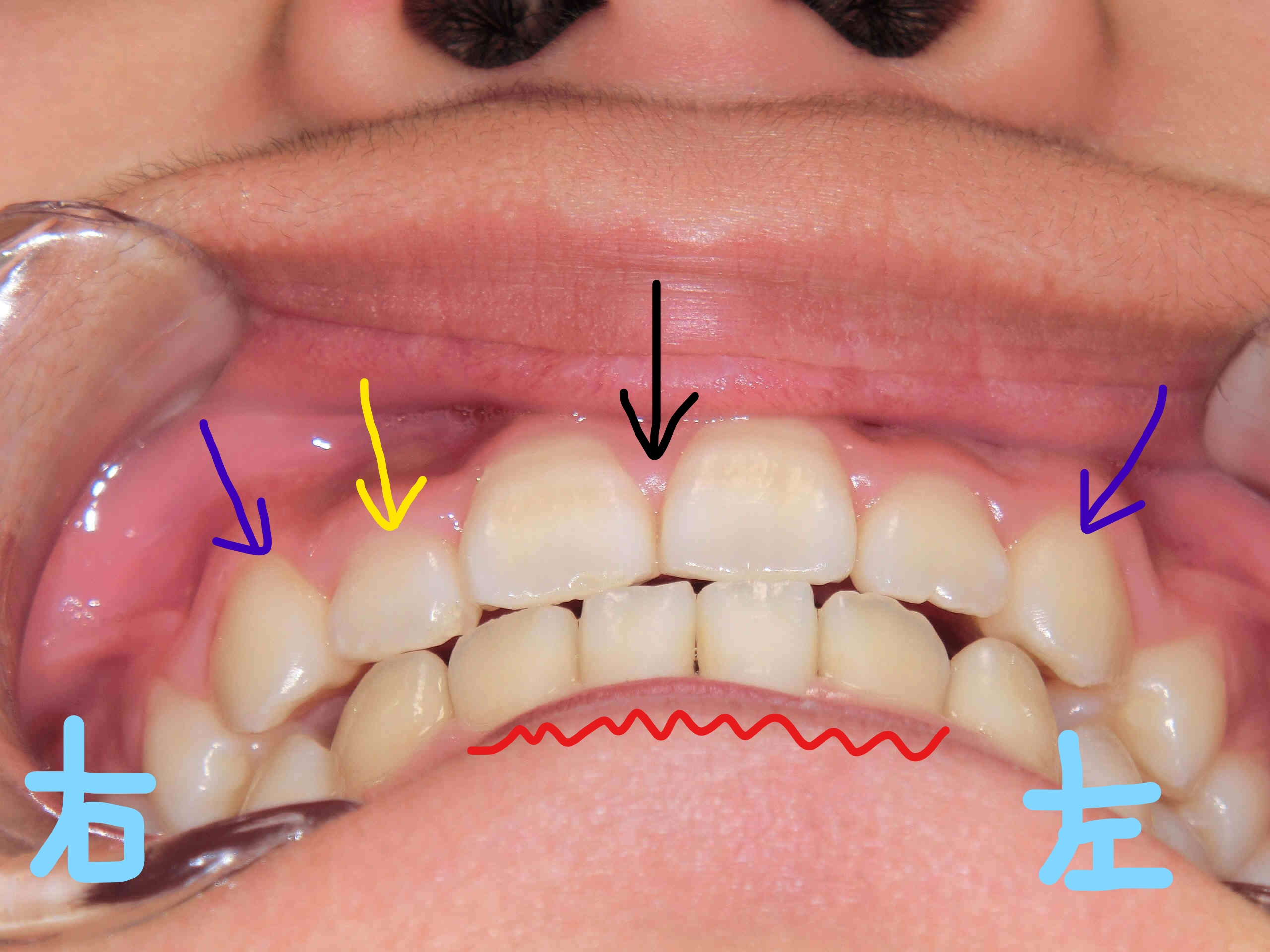 術後レントゲン
