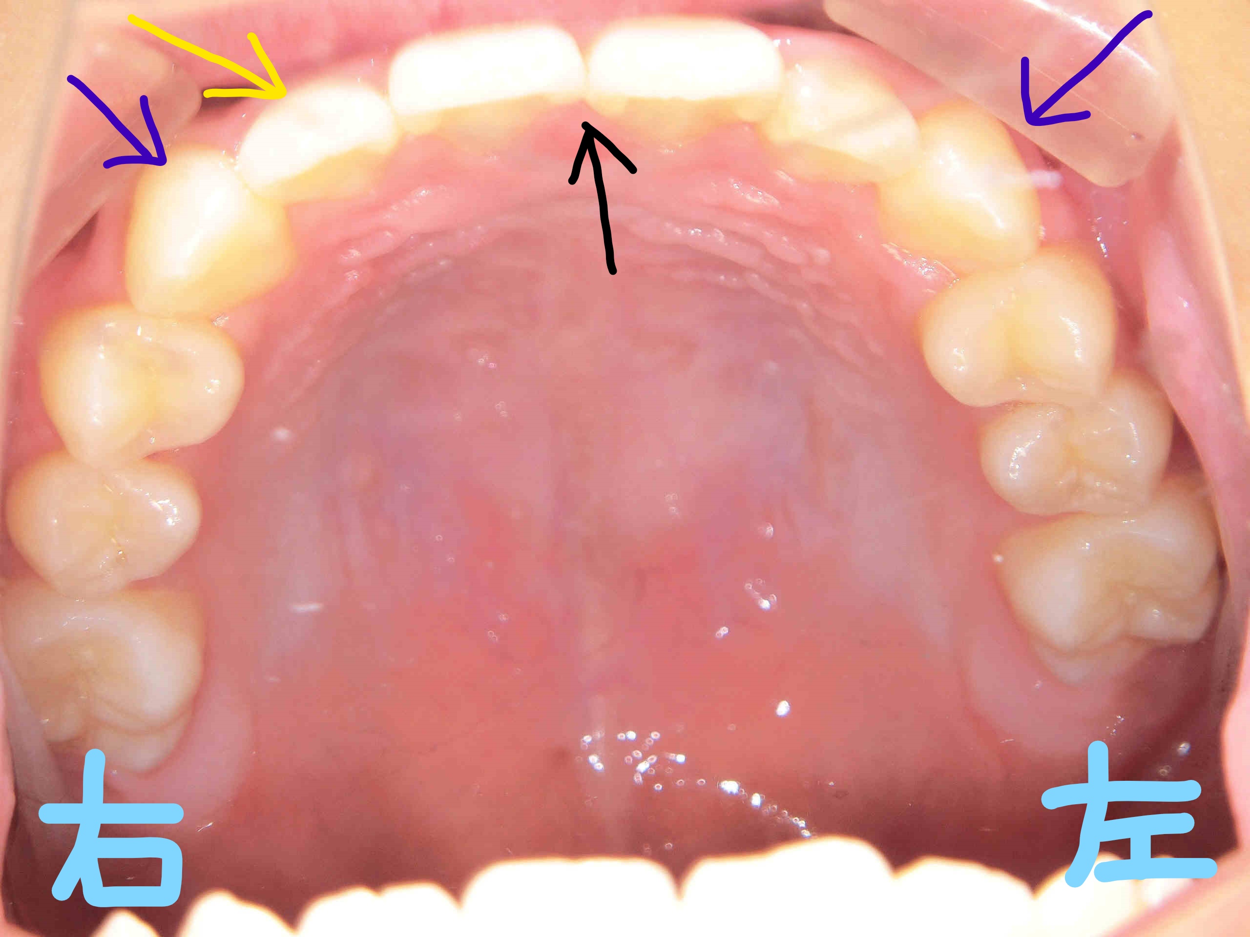 術前レントゲン